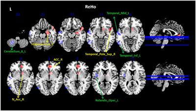 Altered brain activities in mesocorticolimbic pathway in primary dysmenorrhea patients of long-term menstrual pain